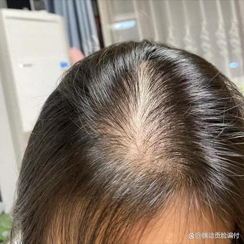 头发少缺少什么