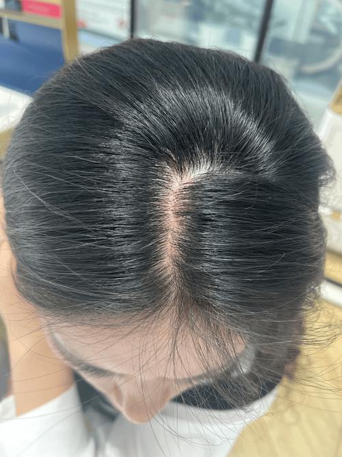 头发少缺少什么