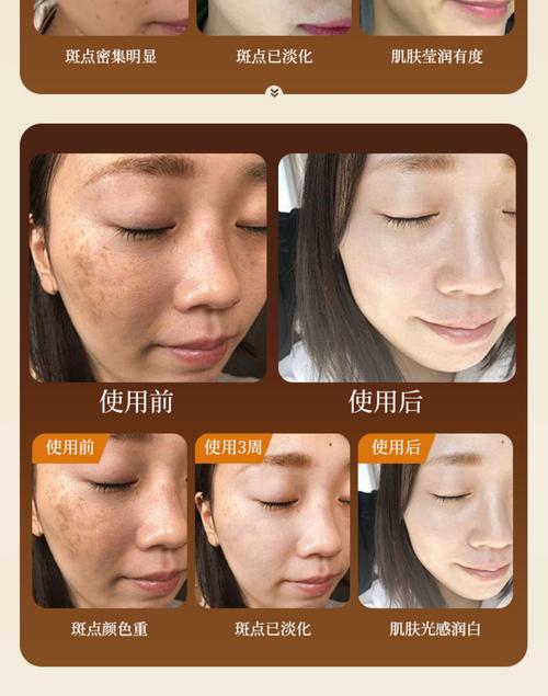 斑有什么办法去掉