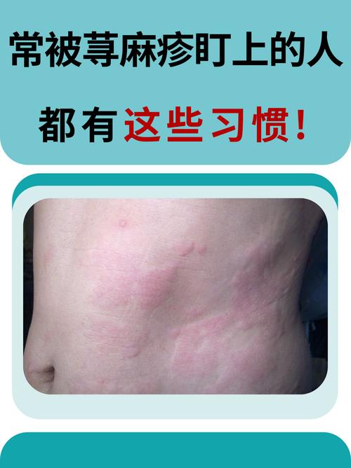 皮肤为什么老是过敏