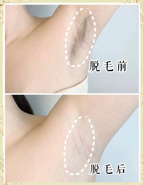 脱毛用什么方法最好