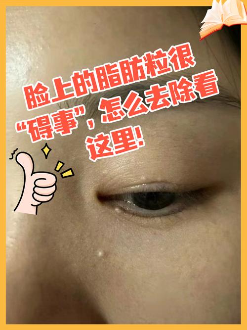 为什么脸上长脂肪粒