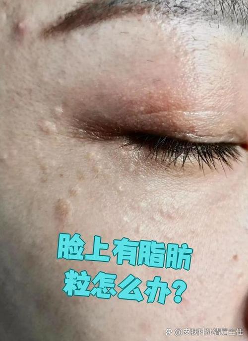 为什么脸上长脂肪粒