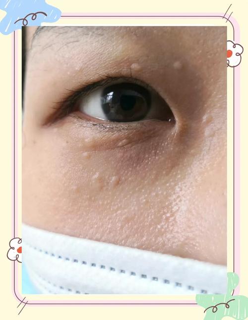 为什么脸上长脂肪粒