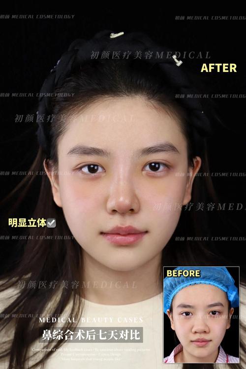 为什么减肥后眼睛变大鼻子变高