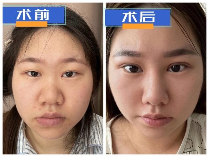 为什么减肥后眼睛变大鼻子变高
