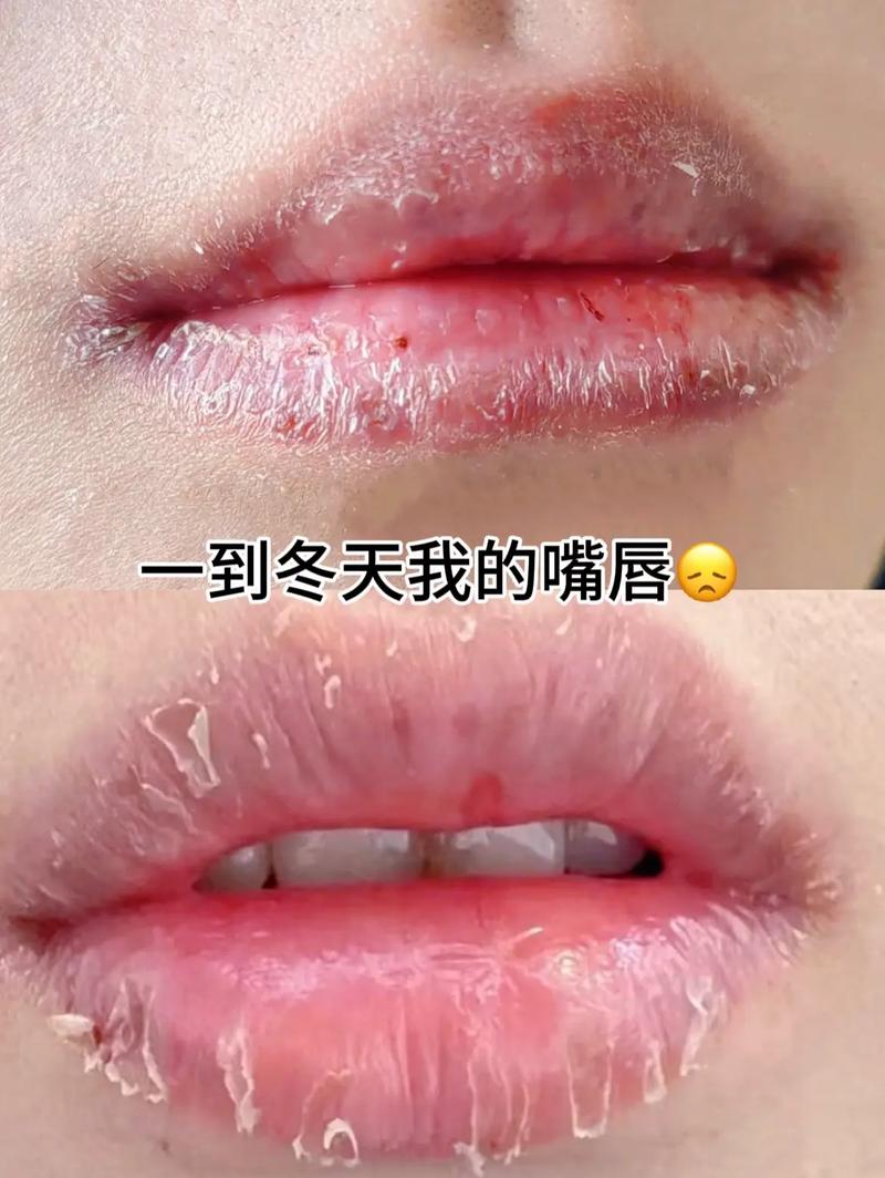 嘴唇干裂脱皮吃什么