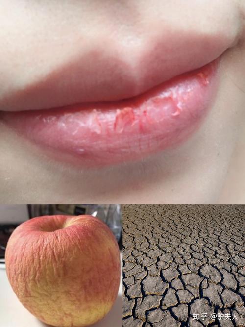 嘴唇干裂脱皮吃什么