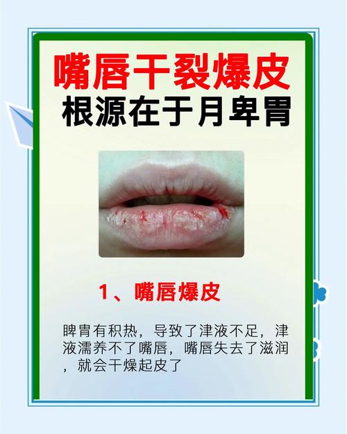 嘴唇干裂脱皮吃什么