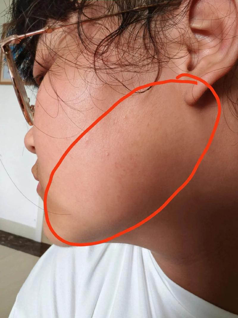 脸有点肿是什么原因