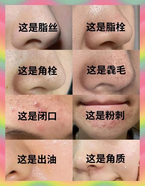 用什么去黑头效果好