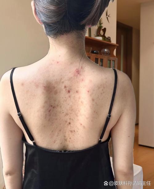 为什么背上会长痘