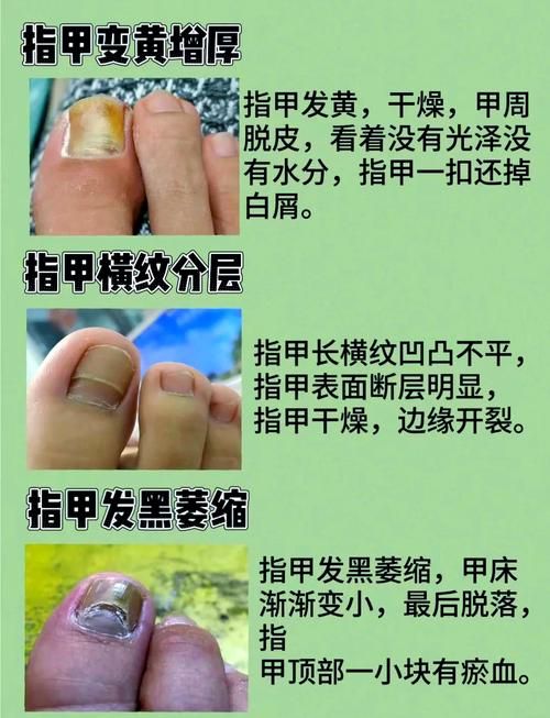 灰指甲有什么影响