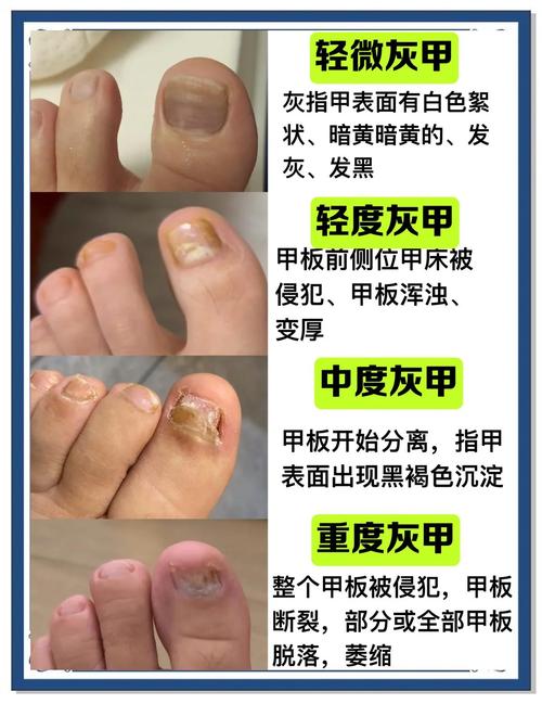 灰指甲有什么影响