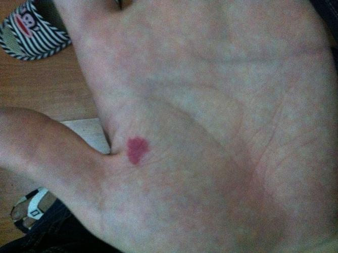 手上有胎记代表什么