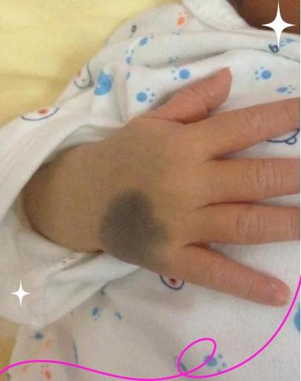 手上有胎记代表什么