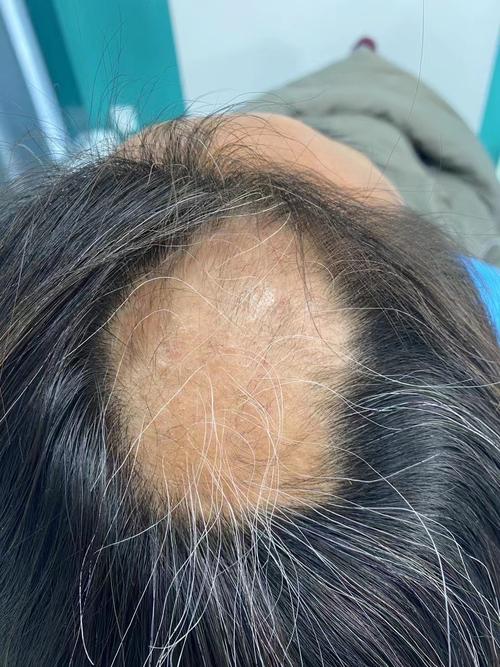 斑秃有什么症状