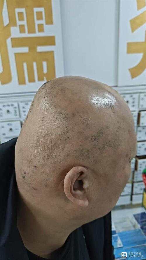 斑秃有什么症状