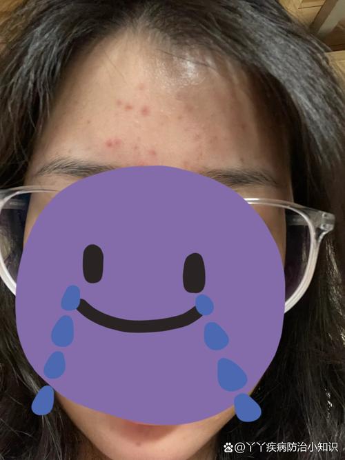 额头长痘痘吃什么药