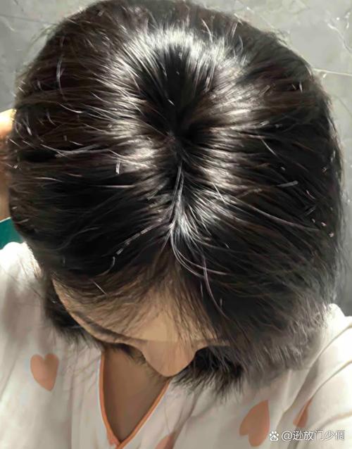 为什么头顶头发少