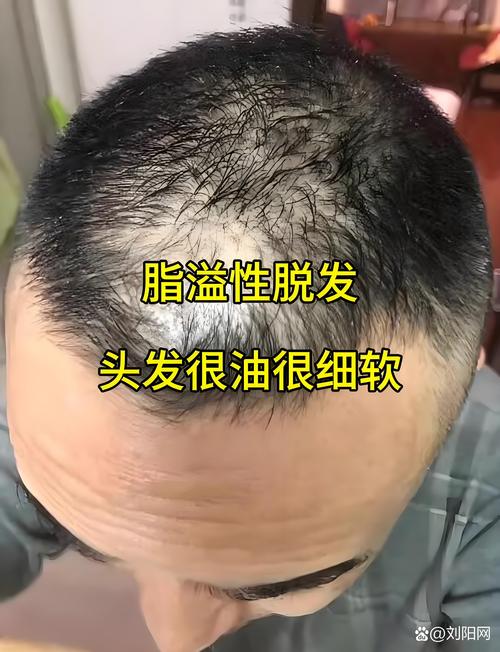 为什么头顶头发少