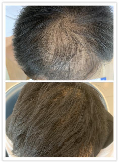 为什么头顶头发少