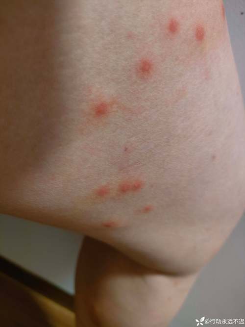 皮肤阳性什么意思