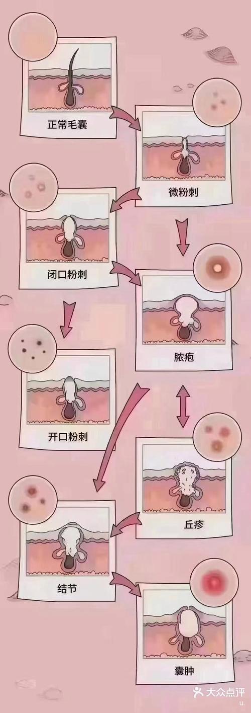 什么是毛囊堵塞