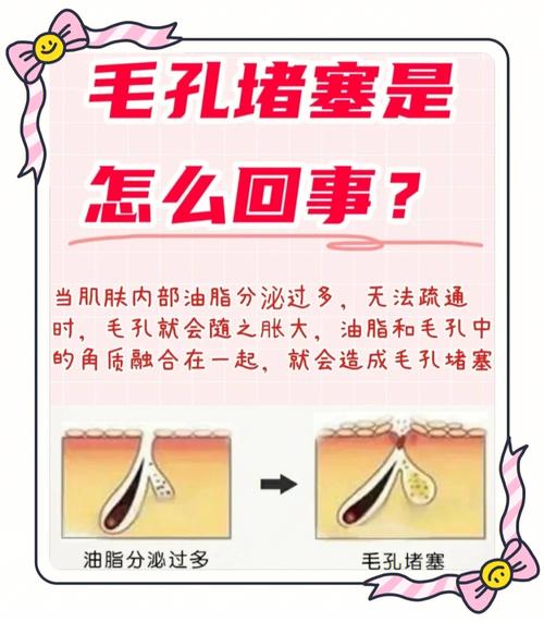 什么是毛囊堵塞