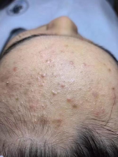 什么是毛囊堵塞