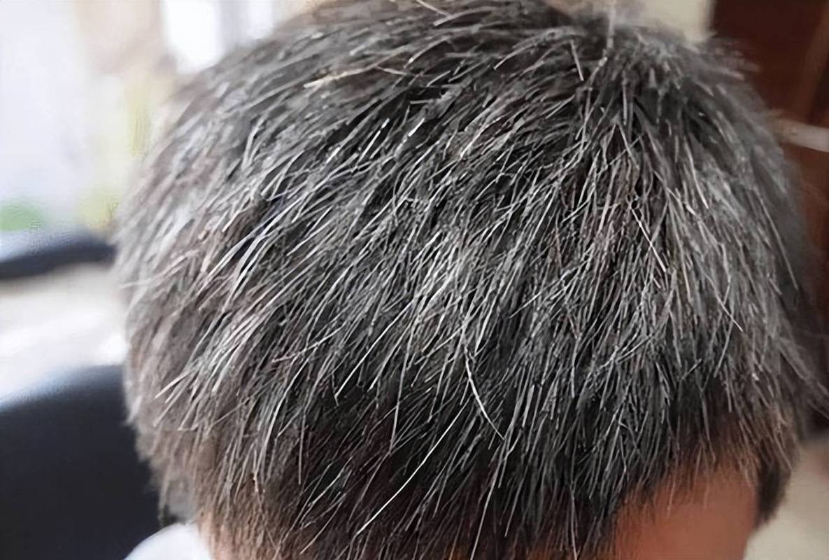 为什么这么多白头发