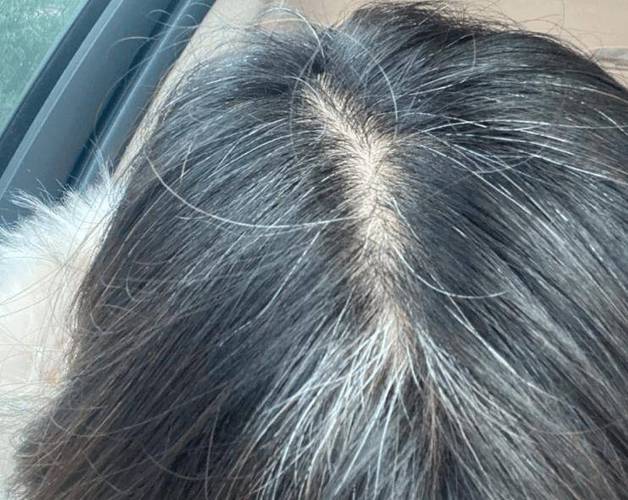 为什么这么多白头发