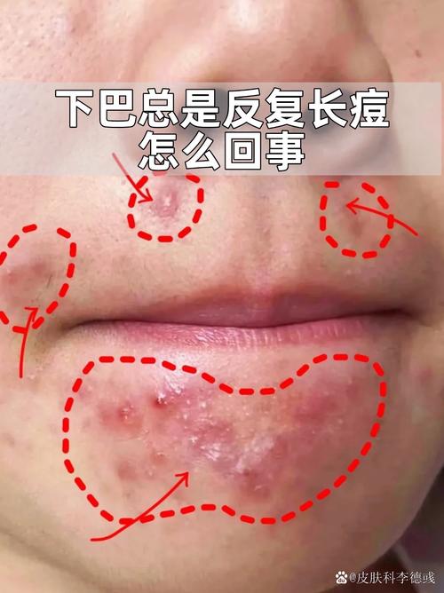 为什么下巴总是长痘