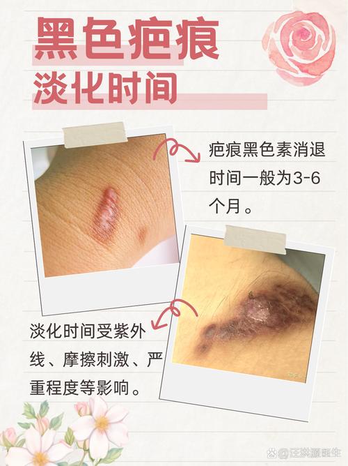 疤痕为什么会变黑