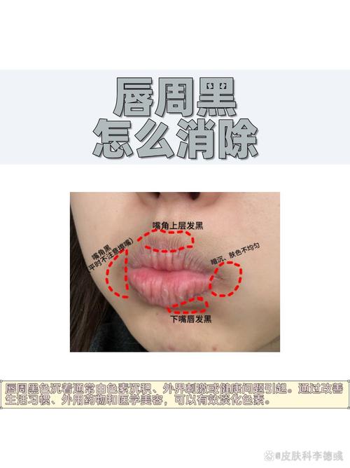 为什么唇变厚