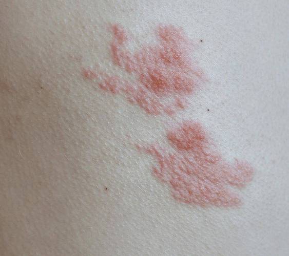 疱疹的症状是什么样的