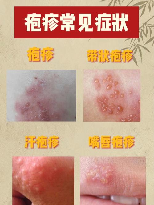 疱疹的症状是什么样的
