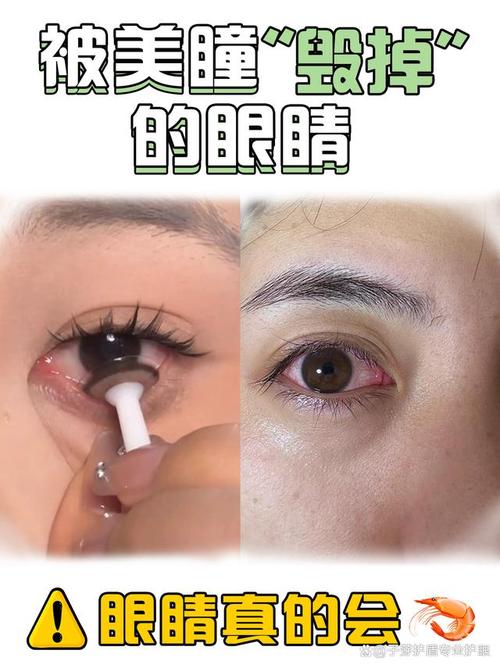 带美瞳有什么危害