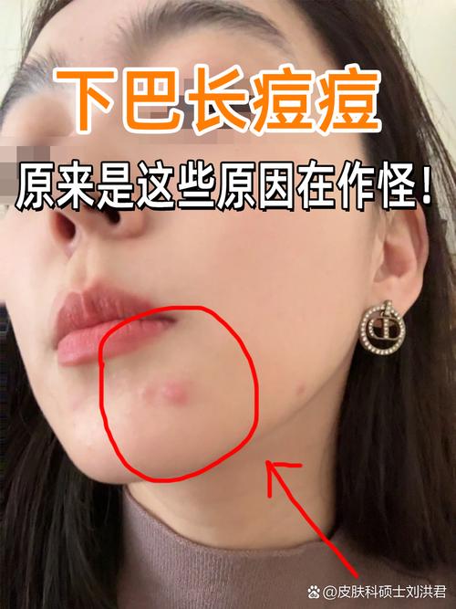 为什么下巴总长痘