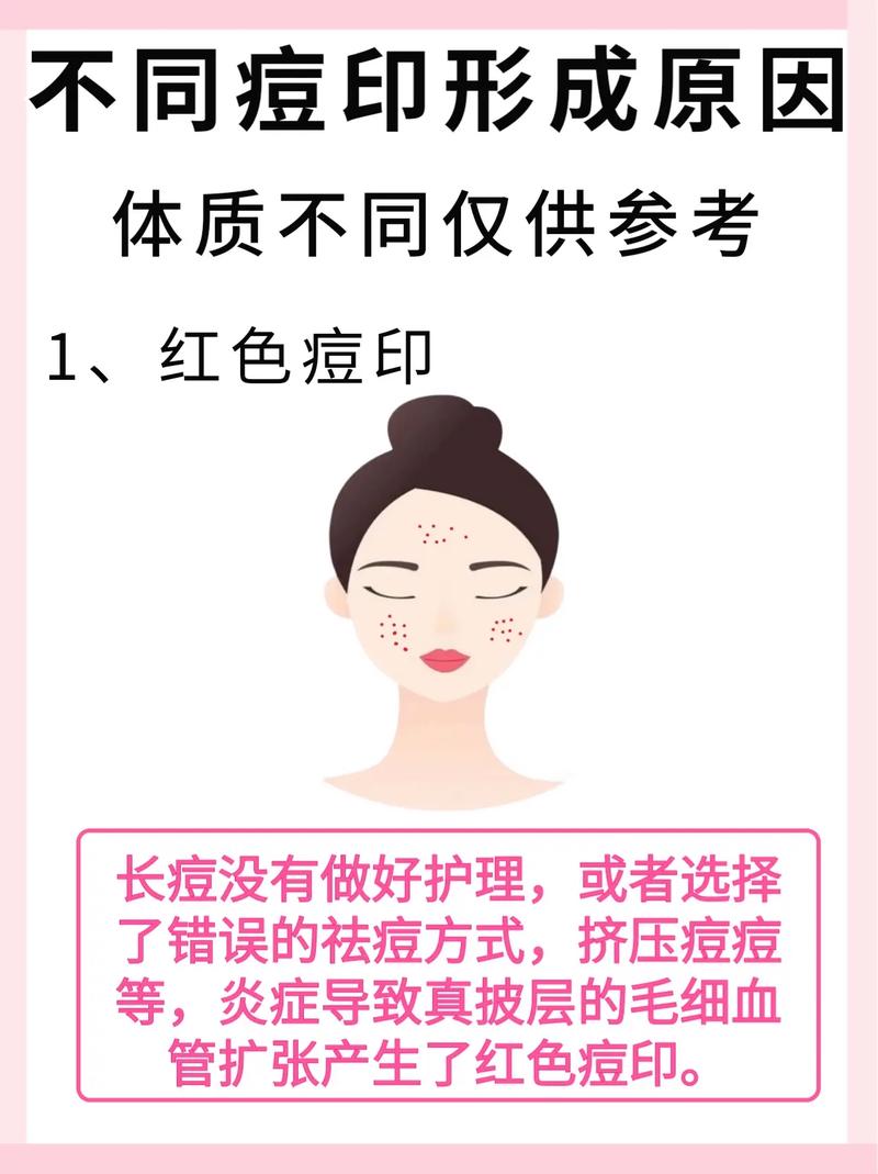 为什么会留下痘印