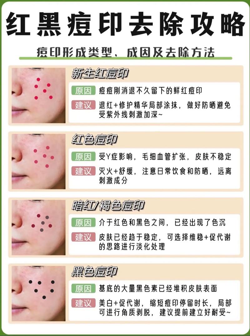 为什么会留下痘印