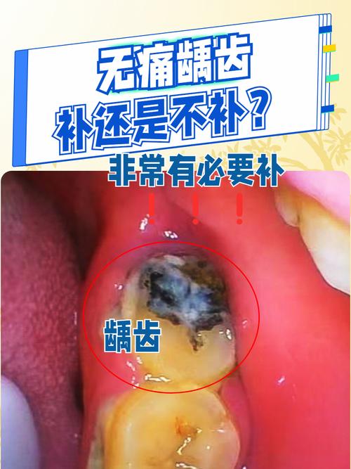 牙齿为什么容易蛀牙