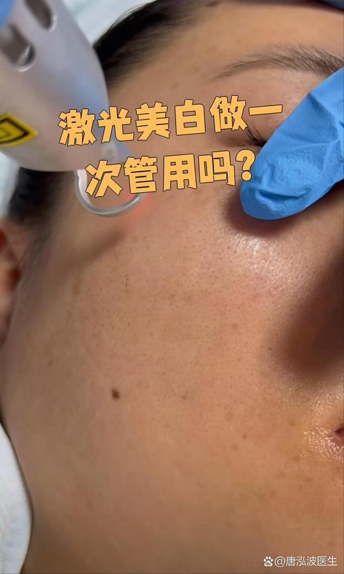 激光美白是什么