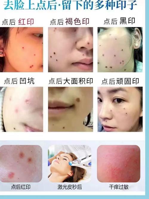 激光点痣涂什么药