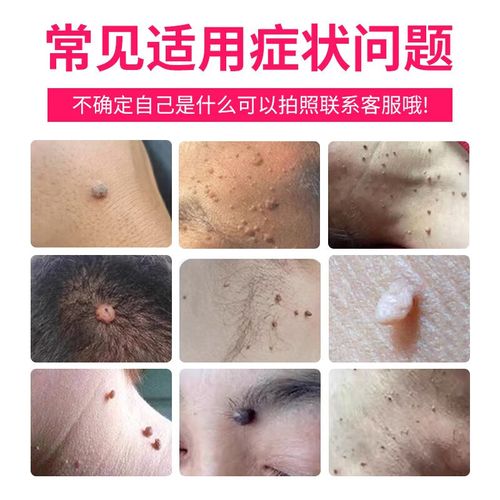 激光点痣涂什么药