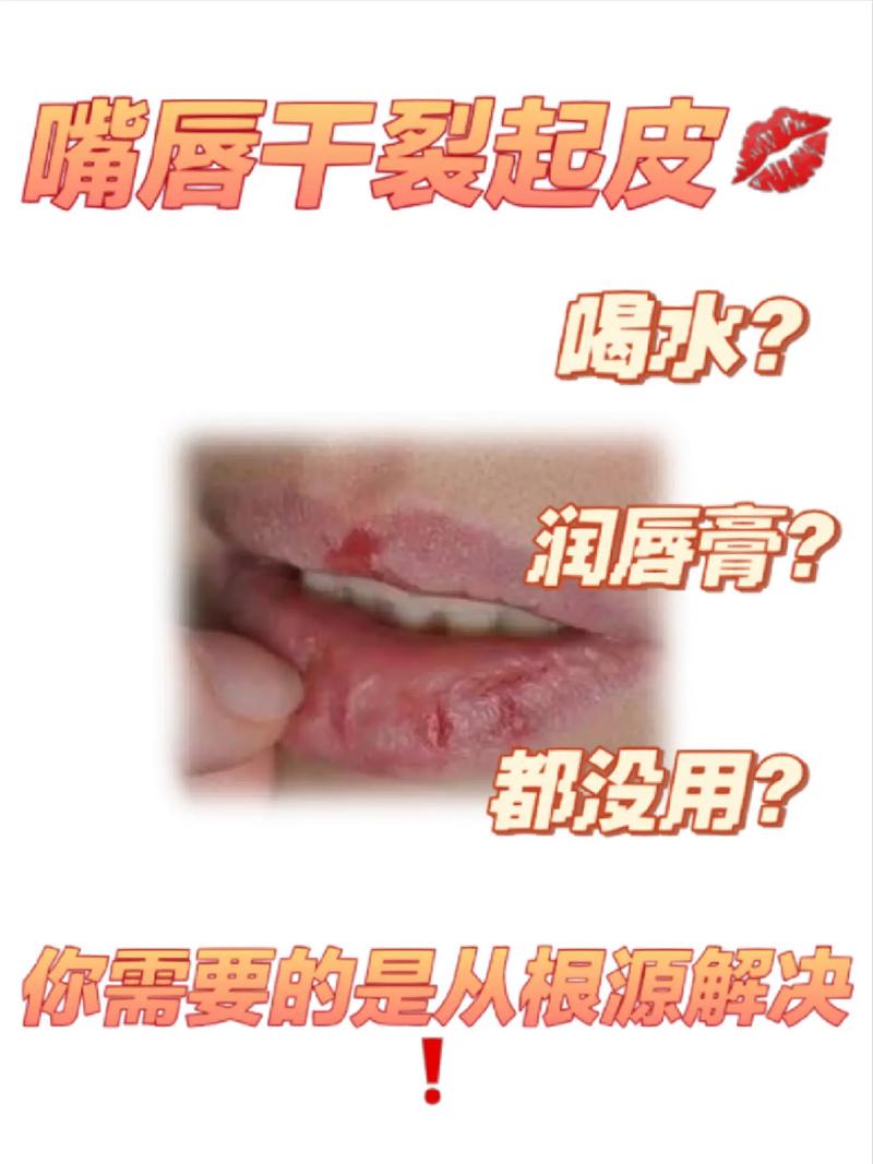 嘴角脱皮是什么原因
