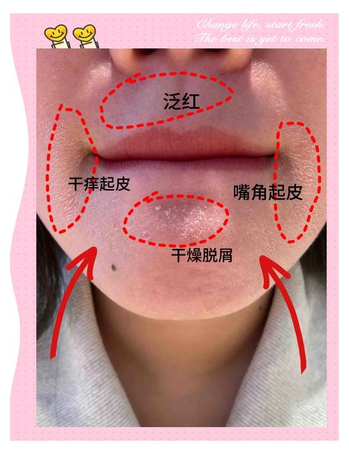 嘴角脱皮是什么原因