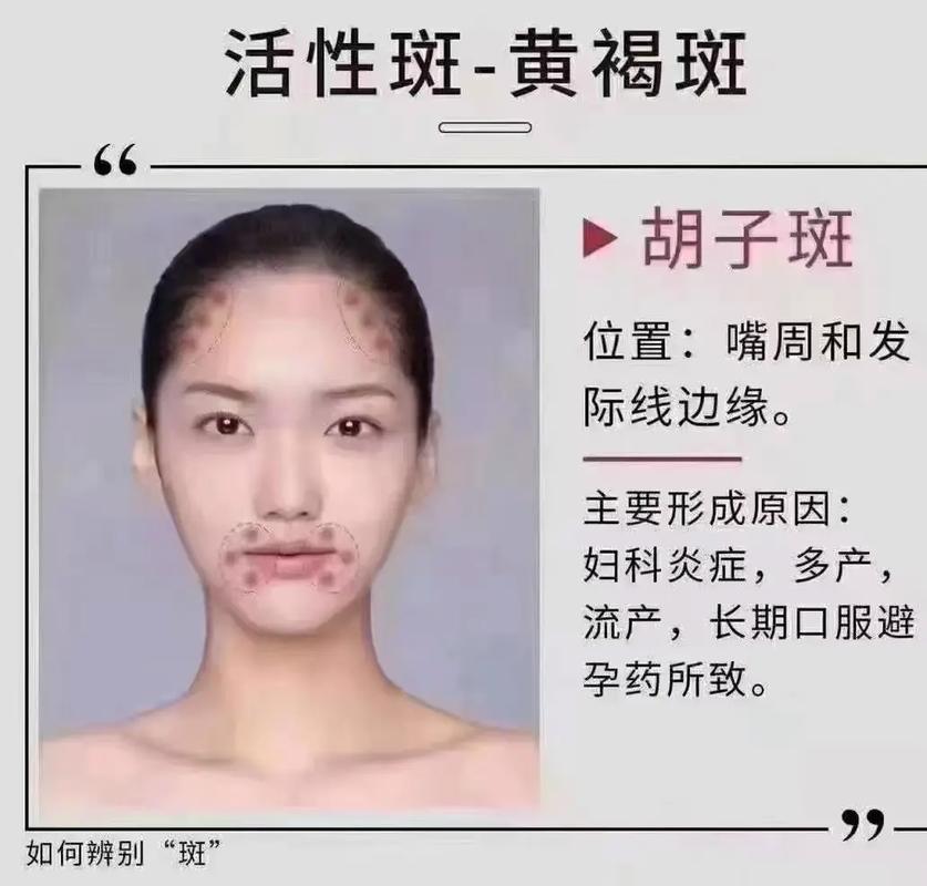 女人为什么会长斑