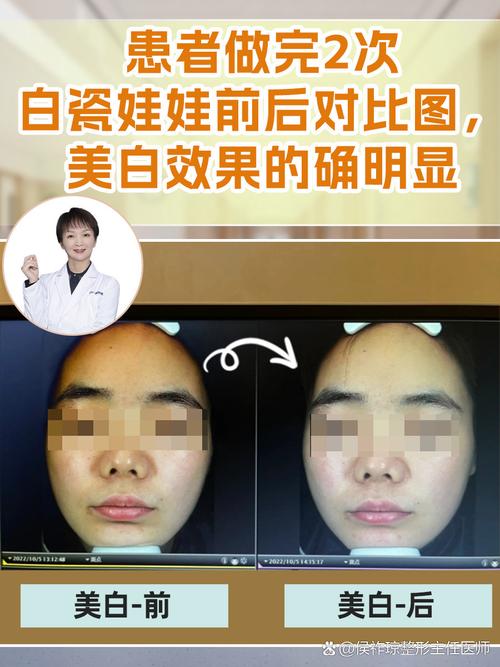 白瓷娃娃是什么