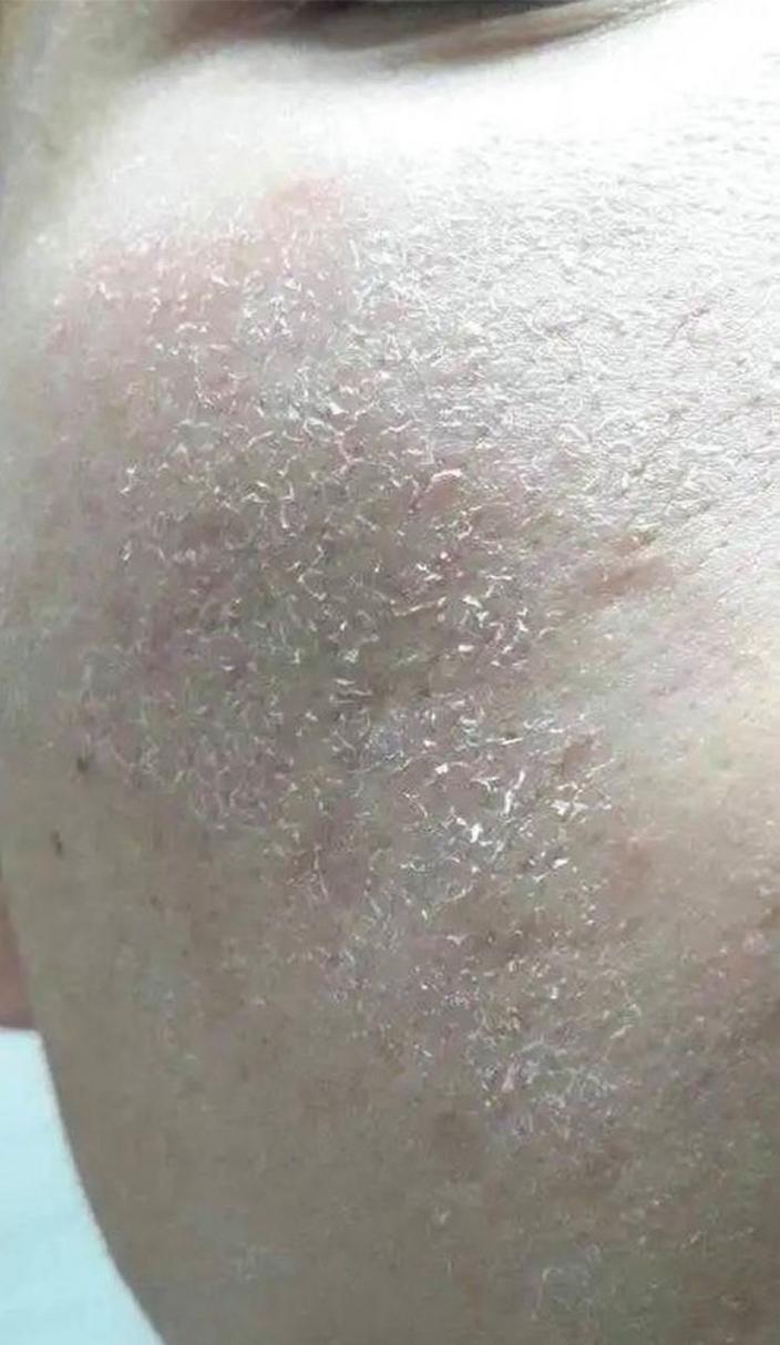 为什么脸上掉皮屑